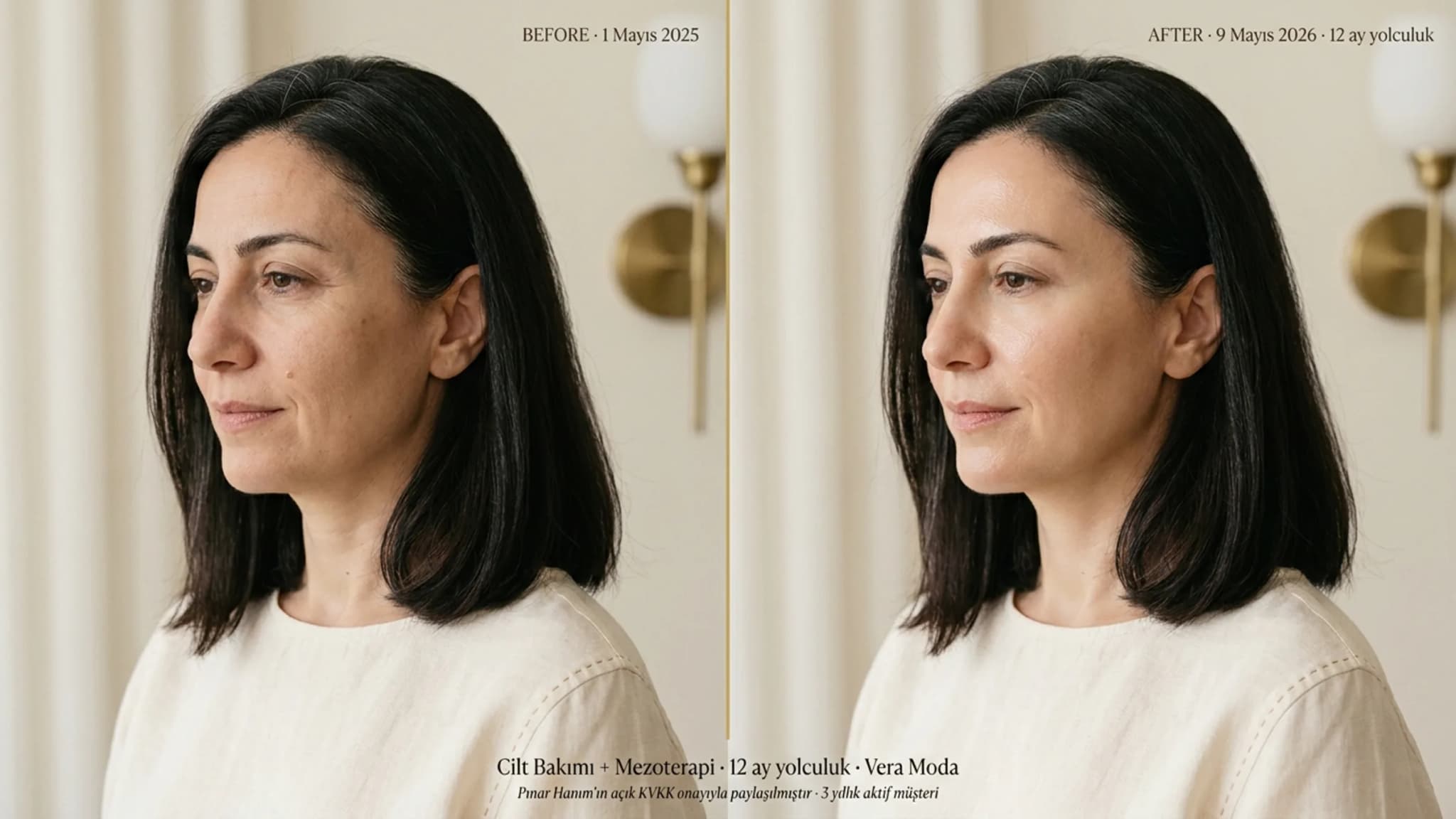 Pınar Hanım cilt bakımı + mezoterapi 12 ay yolculuk before/after mature beauty editorial