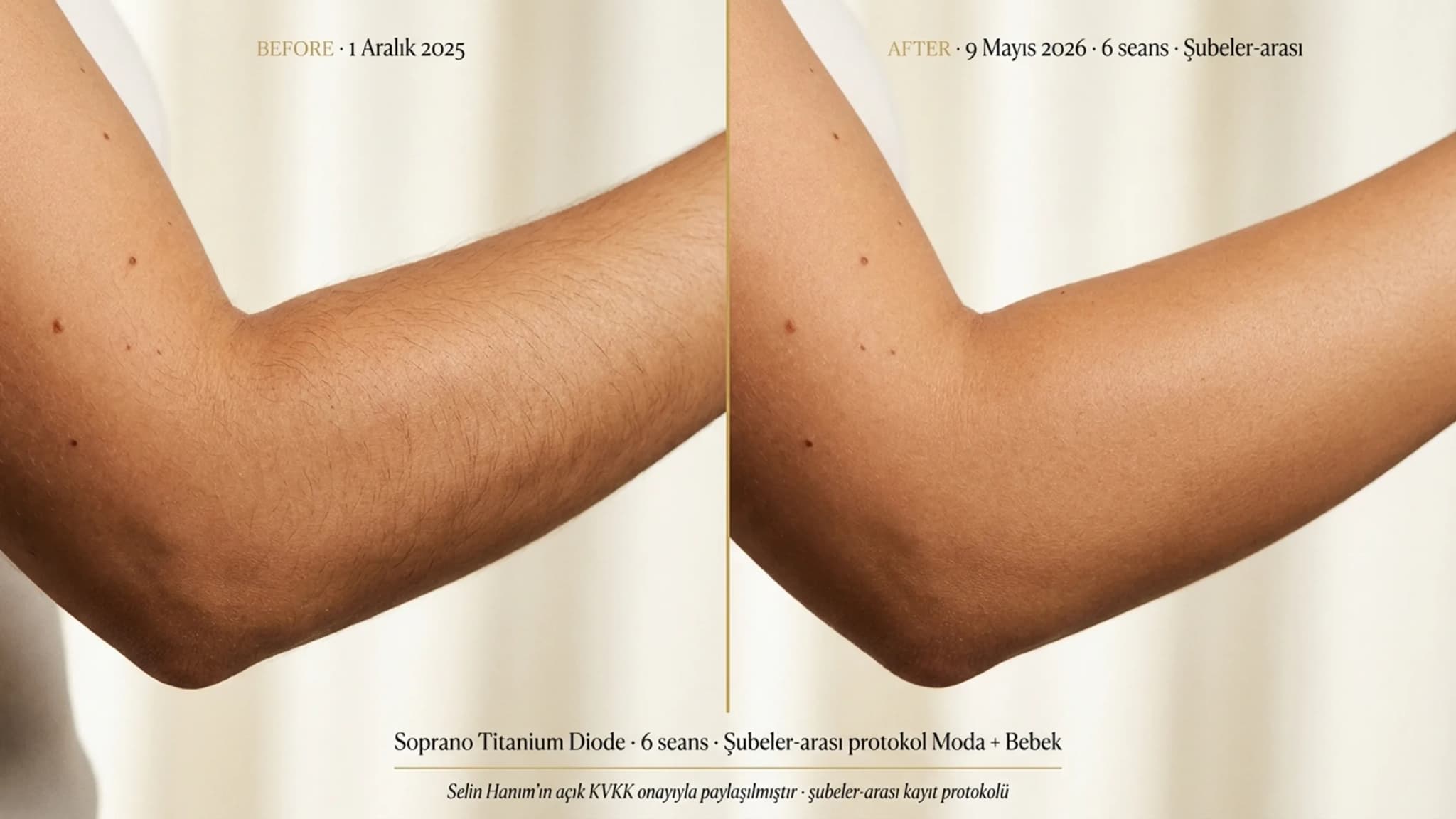 Selin Hanım Diode lazer 6 seans şubeler-arası before/after body editorial