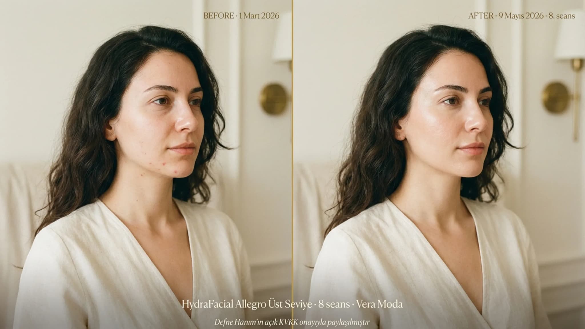 Defne Hanım HydraFacial Üst Seviye 8 seans before/after editorial split-frame
